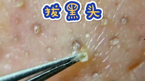 挤黑头视频,专业技巧与注意事项
